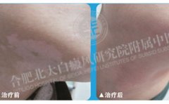 脖子上的白癜風如何治